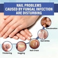 thumbnail image 4 of Nail Led Light Therapy-device,nail Repair Instrument To Prevents Broken Nails And Rotten Nails GuanGuan, 4 of 5