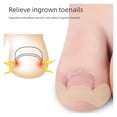 thumbnail image 2 of 20 Sheets - Free Toenail Correction Patches: Toenail Correction Patches for Ingrown Toenails, Nail Fissures, and Curled Toenails, 2 of 6