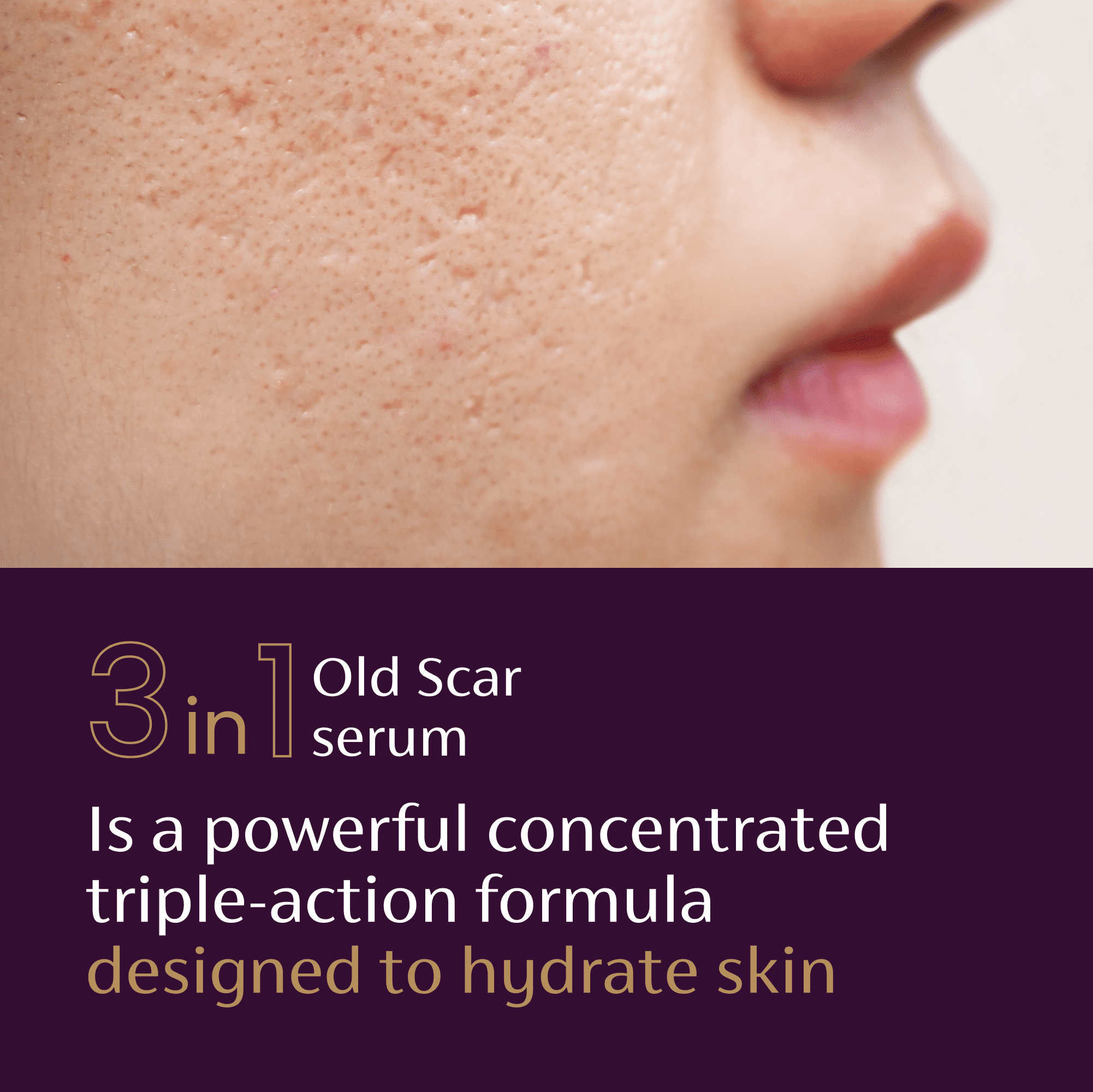 (3 pack) Mederma Scar Serum – Triple-Action Formula with Vitamin E, Hyaluronic Acid & Niacinamide – Clinically Shown to Reduce Old Scars,  1 Fl. Oz.