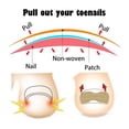 thumbnail image 6 of Ingrown Toenail Corrector Patch, 20 Pcs - Toe Patch for Fast Pedicure & Foot Care, Foot Masks Easter Mother'S Day Base Care Makeup Organizers, 6 of 8