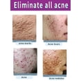 thumbnail image 4 of Crema de tratamiento para el acné, árbol de té, Control de aceite retráctil de poros, blanqueamiento, reparación de granos, Limpieza Profunda, hidratante antiacné, cuidado de la piel facial, 4 of 5