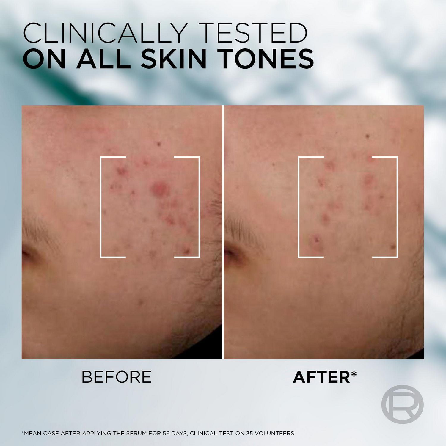 L'Oréal Paris Men Expert Derma Power Correcting Acne Serum, 30 ml