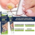 thumbnail image 2 of Nail Fungus Treatment Cream, 20g Toenail Fungus Treatment Cream, Strong Anti-Fungal Toenail Cream, Fungal Nail Treatment Cream, 2 of 5