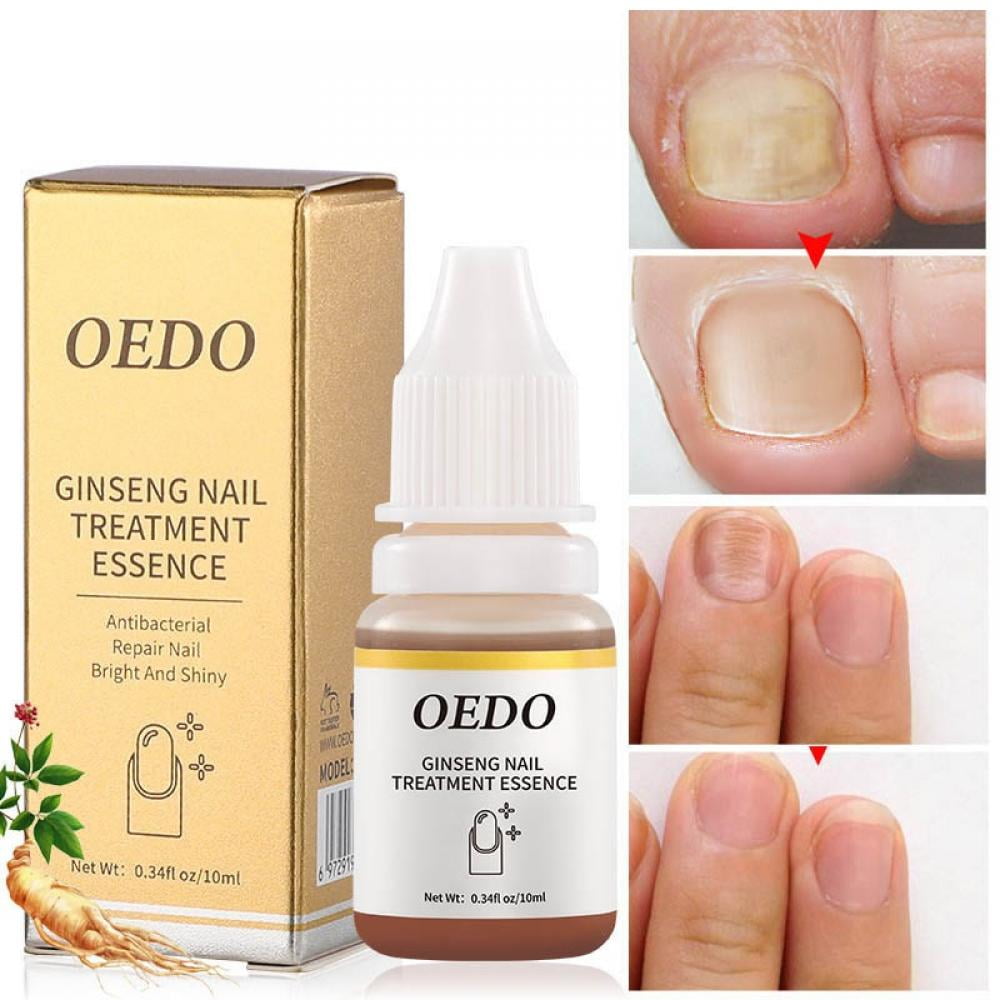 Big Clearance! Finger & Toenail Fungus Organic Nail Fungus Cure