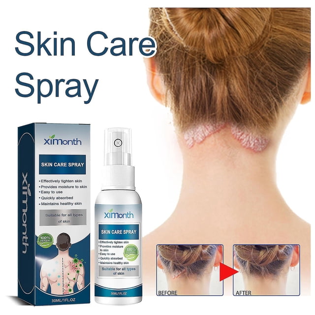 Tratamiento de psoriasis en aerosol, terapia de recuperación del cuero cabelludo, control de psoriasis para la recuperación de la piel, hidratación