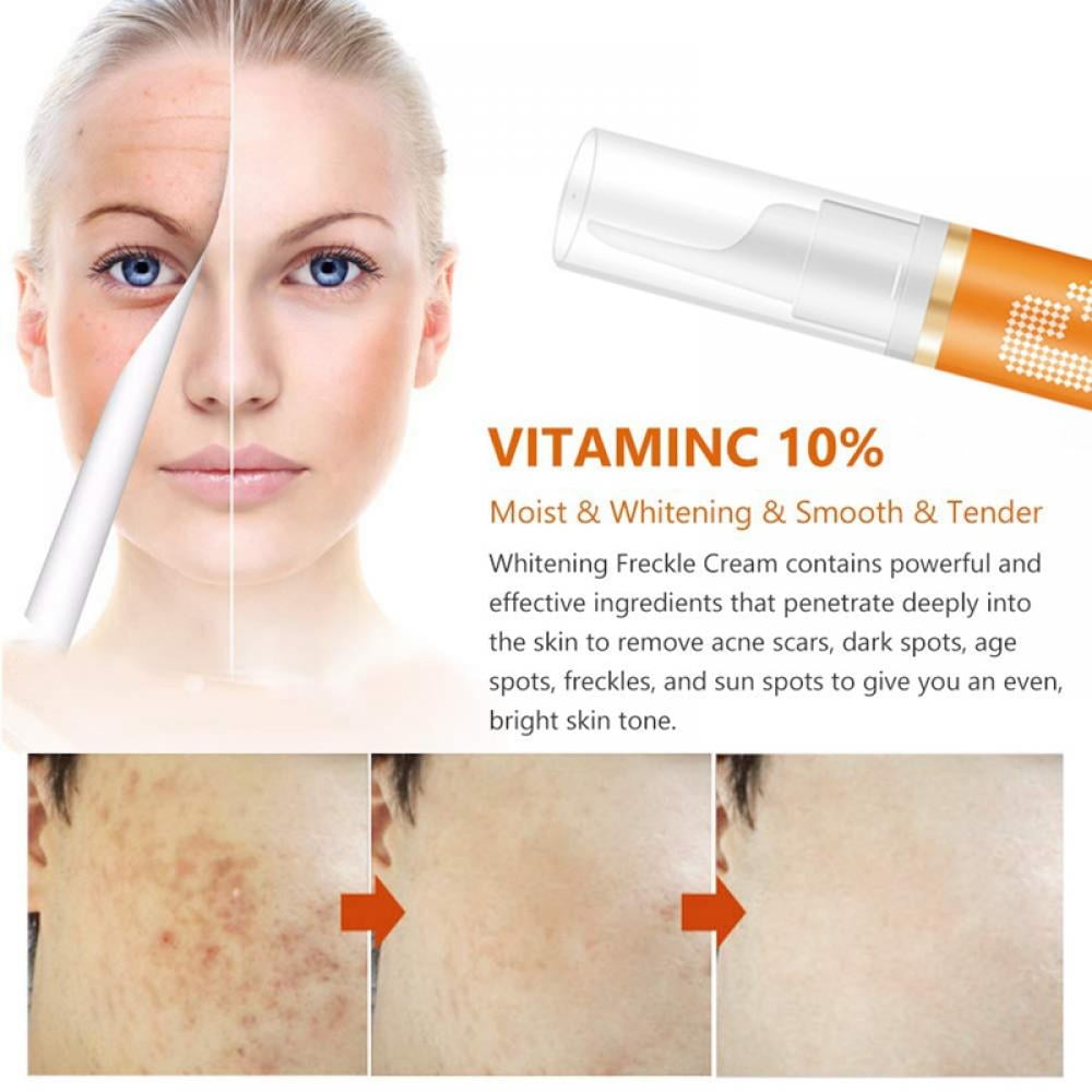 Buy Freckle Remover Cream, for Face Melasma Treatment Fade Cream with Synovea, Kojic Acid