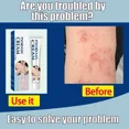 thumbnail image 5 of Pomada antimicrobiana para Psoriasis, tratamiento de Dermatitis, Eczema, antipicazón, alivia erupciones, Urticaria, descamación, Care9127, 5 of 5