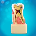 thumbnail image 5 of Modèle Éducatif Dentaire 1 Pce Modèle Complet de Caries Pathologiques Modèle Dentaire Valeur Imbattable, 5 of 5