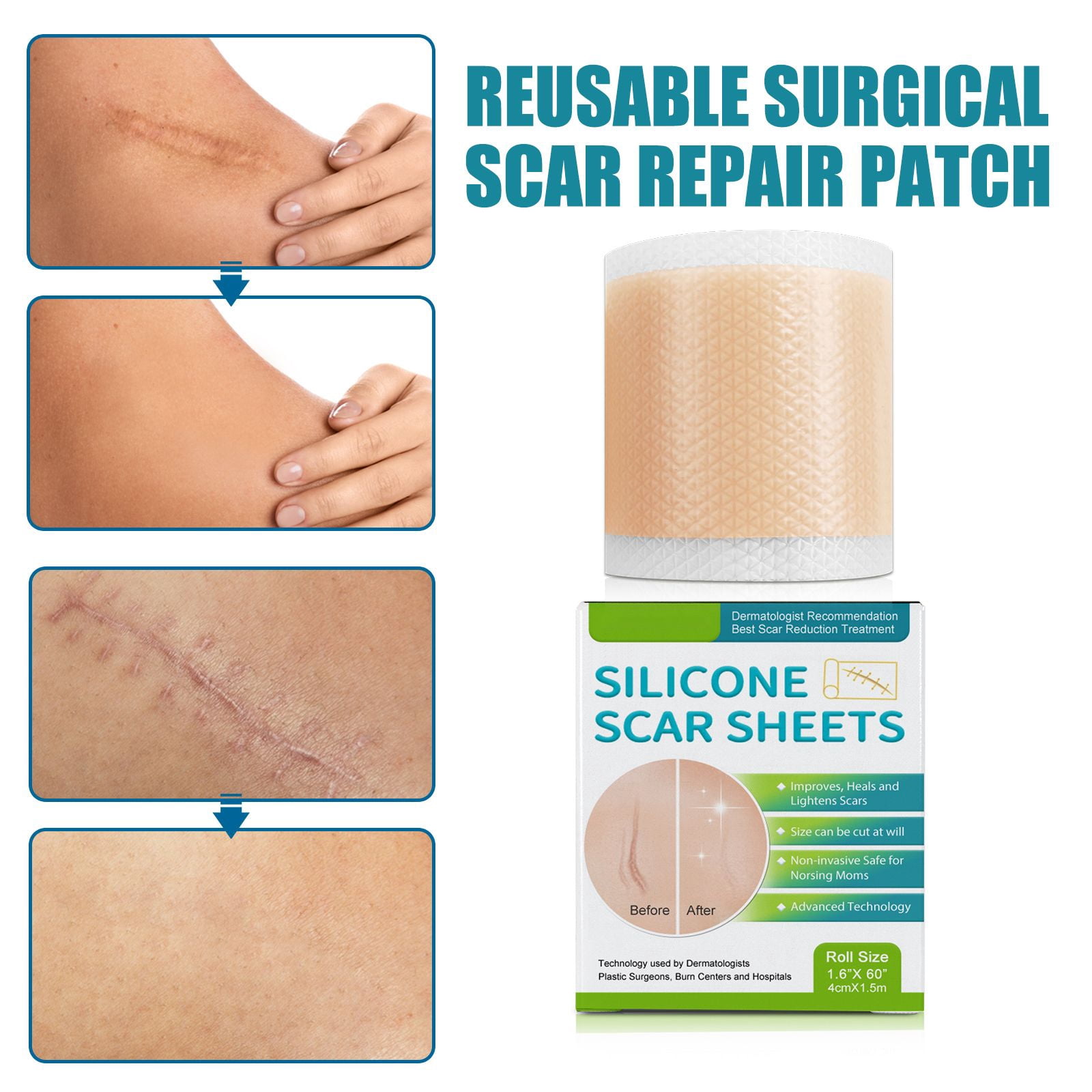 Alvantor Silicone Scar Sheets - Medical Grade Scar Tape Roll for C-Section, Surgery, Burn, Acne Scars Treatment, 1.6"*60"