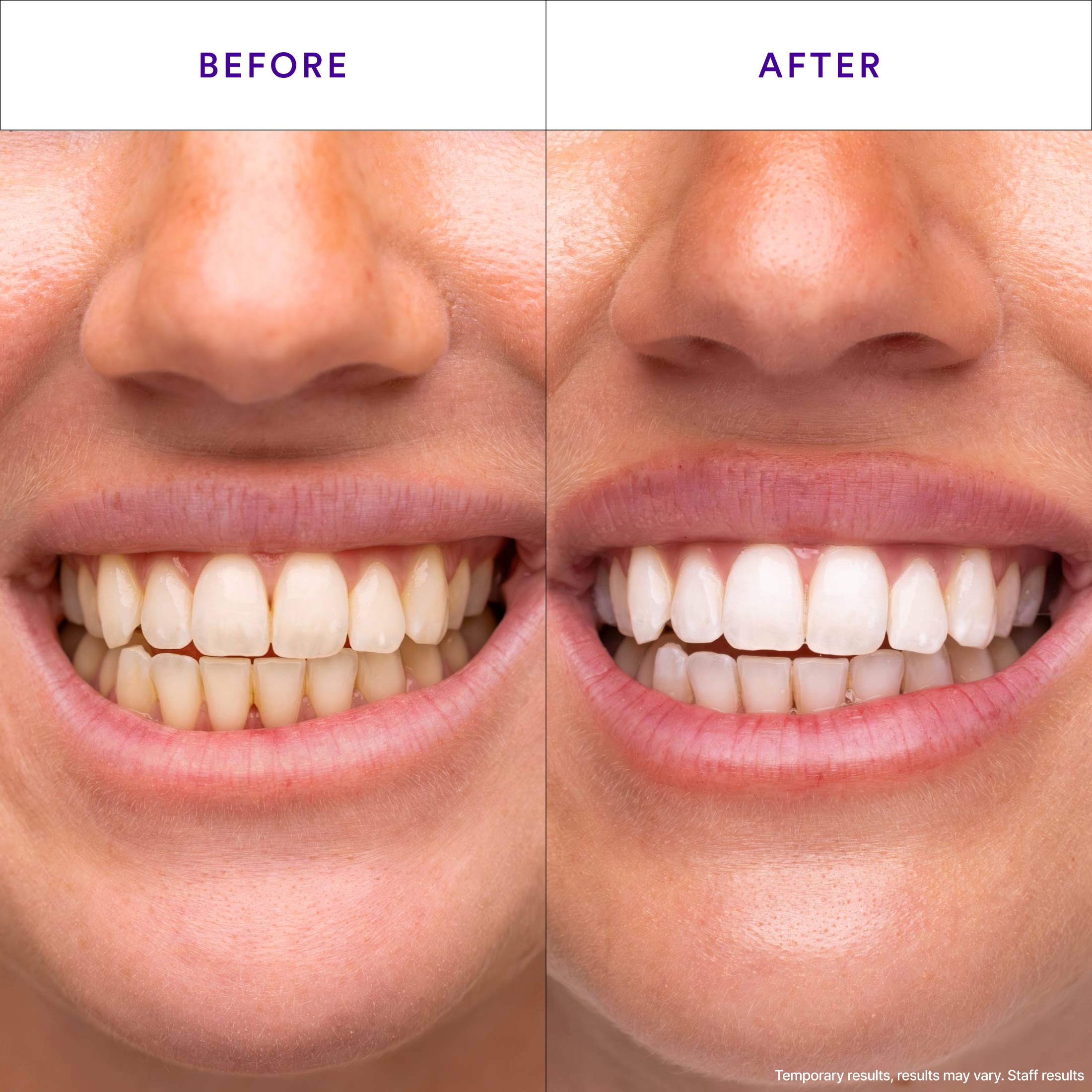 HiSmile V34 Purple Whitening Strips Teeth Whitening photo 2