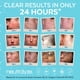 thumbnail image 4 of Almohadillas exfoliantes para el tratamiento del acné Neutralyze, 100 unidades, 4 of 6