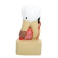 thumbnail image 2 of Caries Study Model, Tooth Teaching Model, Resin Material, Pathological Disease for Dentist Communication,  Education for All Ages, 2 of 7