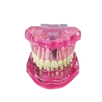 2025 Modelos dentales Modelos de resina reparables de dientes enfermos para la enseñanza y la investigación en medicina y enfermedades dentales
