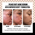 thumbnail image 3 of Serum Peace Out Skincare Acne 2% Ácido Salicílico 30 ml, 3 of 6