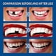 thumbnail image 5 of False Teeth Solid Glue Temporary Tooth Repair Kit Moldable Thermal Fitting Teeth Pellet Adhesive, 5 of 5