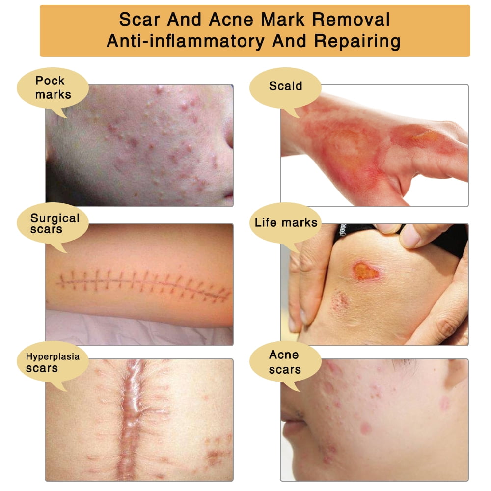 ALIVER Scar Cream - TCM Scar and Acne Mark Removal Gel Ointment for Scars, Burns, Stretch Marks, Acne Spots, Skin Redness Curing - 3 Pack