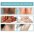 thumbnail image 5 of 1/2/3pcs Acanthosis Cream Nigrifix Cream For Acanthosis Nigricans Black Spot, 5 of 5
