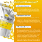 Antifungal Psoriasis Shampoo, Eczema, Shampoo, Seborrheic Dermatitis Shampoo