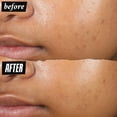 thumbnail image 4 of Pimple Patch Kiehl's Truly Targeted para eliminar el acné, 15 ml, con ácido salicílico, 4 of 8