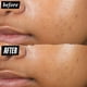 thumbnail image 4 of Pimple Patch Kiehl's Truly Targeted para eliminar el acné, 15 ml, con ácido salicílico, 4 of 8