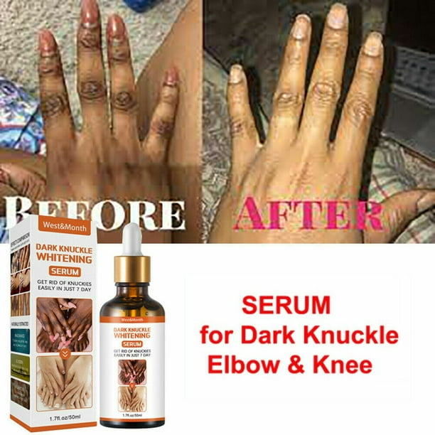 Buy Clear All Dark Knuckles Clear And Dark Spot Remover Carrot