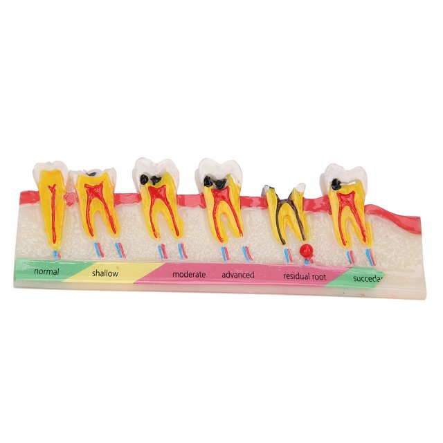 Modelo de desarrollo de caries dental, modelo portátil de dientes cariados para estudio de enseñanza dental