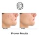 thumbnail image 5 of Las almohadillas para el tratamiento del acné Beauty Facial Extreme eliminan el acné, 5 of 9