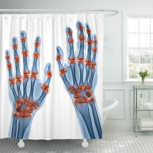 KSADK X Ray of Multible Joint Inflammation in Both Hands Caused by Gout