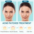 thumbnail image 6 of LotFancy 240 Ct Acne Spot Dots, Acne Pimple Patch, Thin Hydrocolloid Patches, 3 Sizes (12, 10, 8mm), 6 of 7