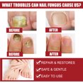 thumbnail image 3 of 2pcs Nail Repair Solution, Hands And Feet Nail Repair Moisturizing Clean And Remove Gray Nail Repair Solution, 3 of 5
