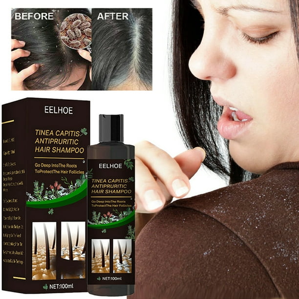 Baloco Anti-Dandruff Shampoo Soothe Scalp Psoriasis Flaky Anti Hair Loss -