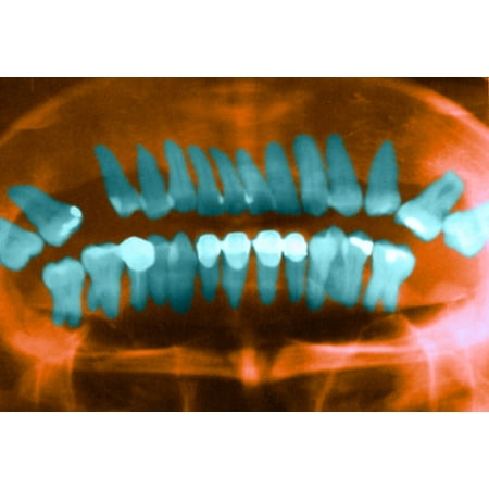 - Panoramic Dental X-Ray Stretched Canvas - Science Source (36 x 24)