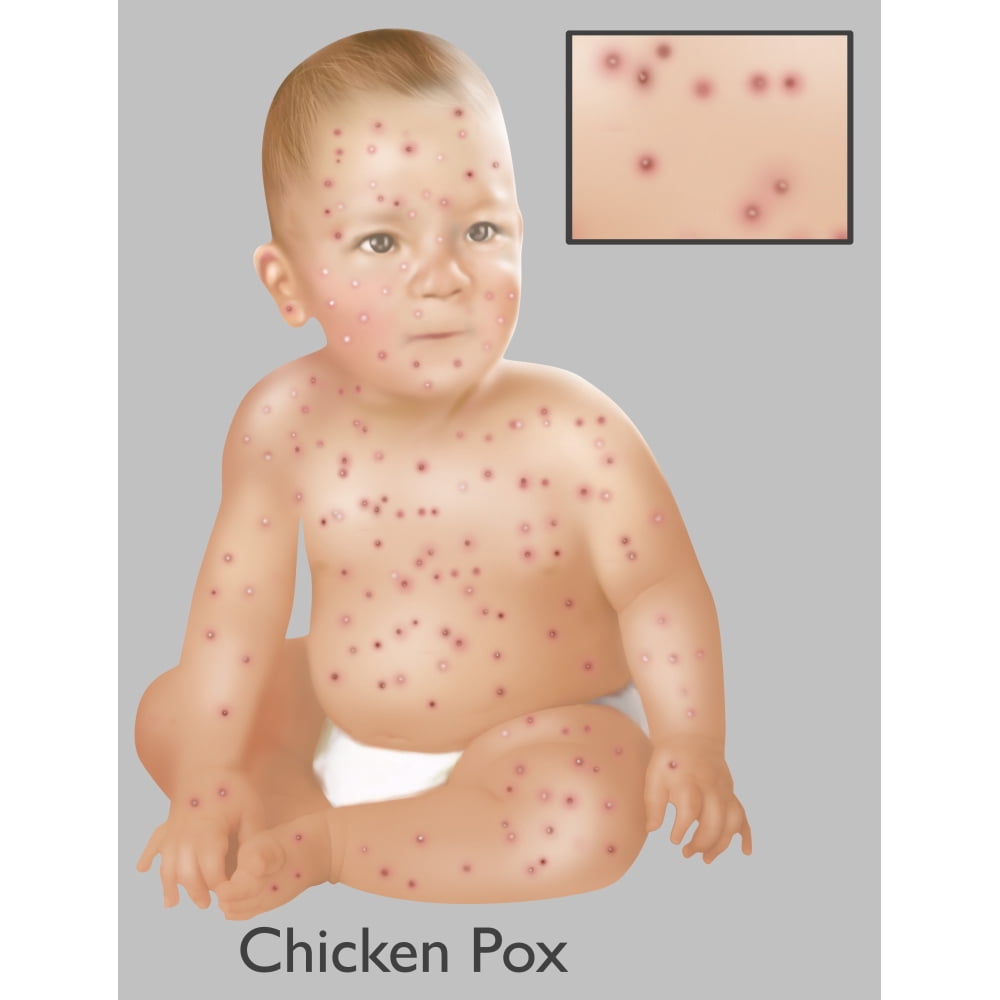 Baby with Chicken Pox Poster Print by Gwen ShockeyScience Source