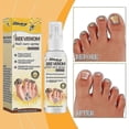 thumbnail image 2 of 2025 Bee Venom Nail Treatment Solution, Bee Venom Nail Fungus Treatment, Extra Strength Nail Repair Solution, Nail Fungus Care Spray, 2 of 5