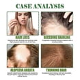 thumbnail image 4 of Rosemary Mint Scalp Hair Growth Essential Oil Nourishing Hair Strengthening Treatment For Split Ends And Dry Hair, 4 of 5