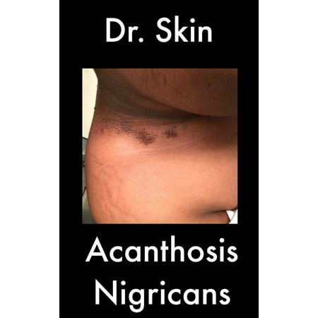 Acanthosis Nigricans - eBook (Best Cream For Acanthosis Nigricans)