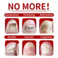 thumbnail image 4 of Hongo de uñas Extra fuerte para pies, cuidado de reparación de uñas, eliminación de hongos para dedos de los pies, antiinfección, nuevo, 4 of 5