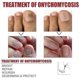 thumbnail image 3 of Nail Treatment Nail Care Manicure And Pedicure Nourishing And Cleansing Removal Of Grey Nails 50ml Box, 3 of 4