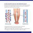 thumbnail image 3 of Venous Spray for Relieving Varicose Vein Pain with Massage Care, 3 of 4