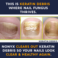 Nonyx Fungal Nail Clarifying Gel - Rids Toenails of Fungus by Removing Keratin Debris Where Nail