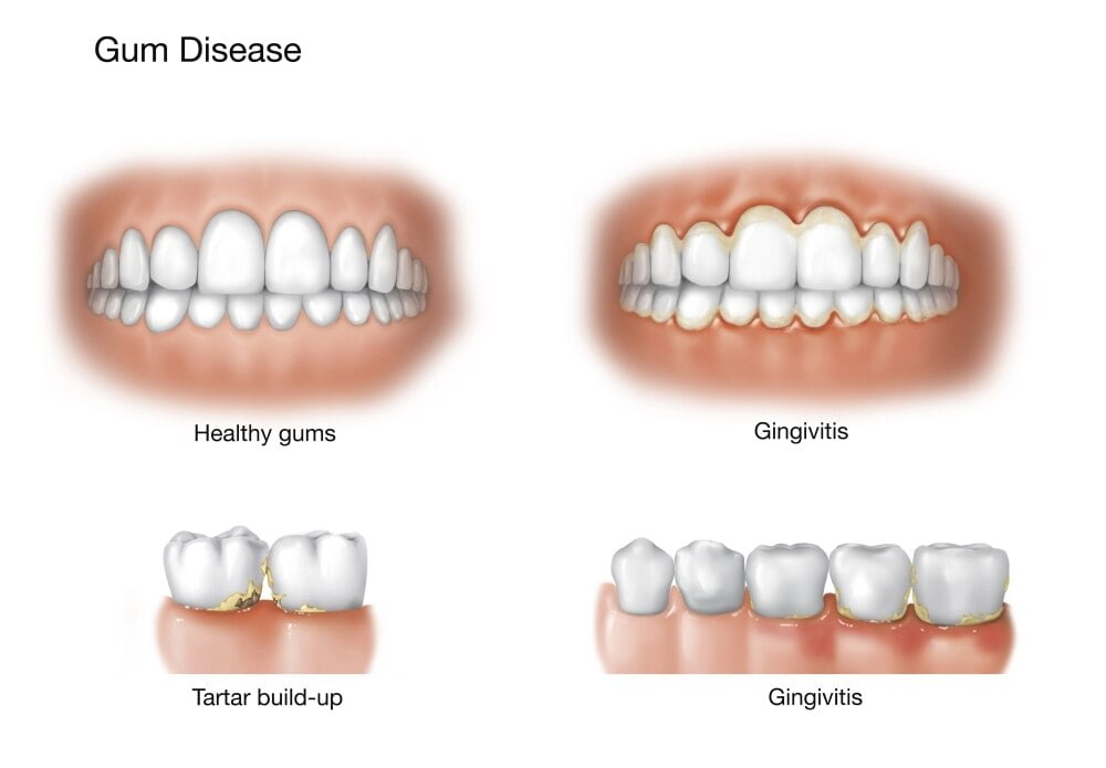 Comparison of healthy gums versus gingivitis. Poster Print by TriFocal