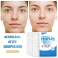 thumbnail image 4 of Medicated Acne Patches For All Skin Types SpotStickers For Face And Skin To Get Ridof Pimples And Pimples 216pcs, 4 of 5