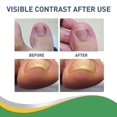 thumbnail image 5 of Jaysuing Toenail Groove Correction Sticker Nail Repair Correction Pull-up Sticker Toe Ingrown Nail Manicure Nail Straightening Sticker -, 5 of 5