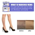 Vein repair cream, massage to relieve earthworm leg muscle bulge pain