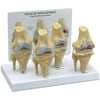 4-Stage Anatomical Human Osteoarthritis Knee Model