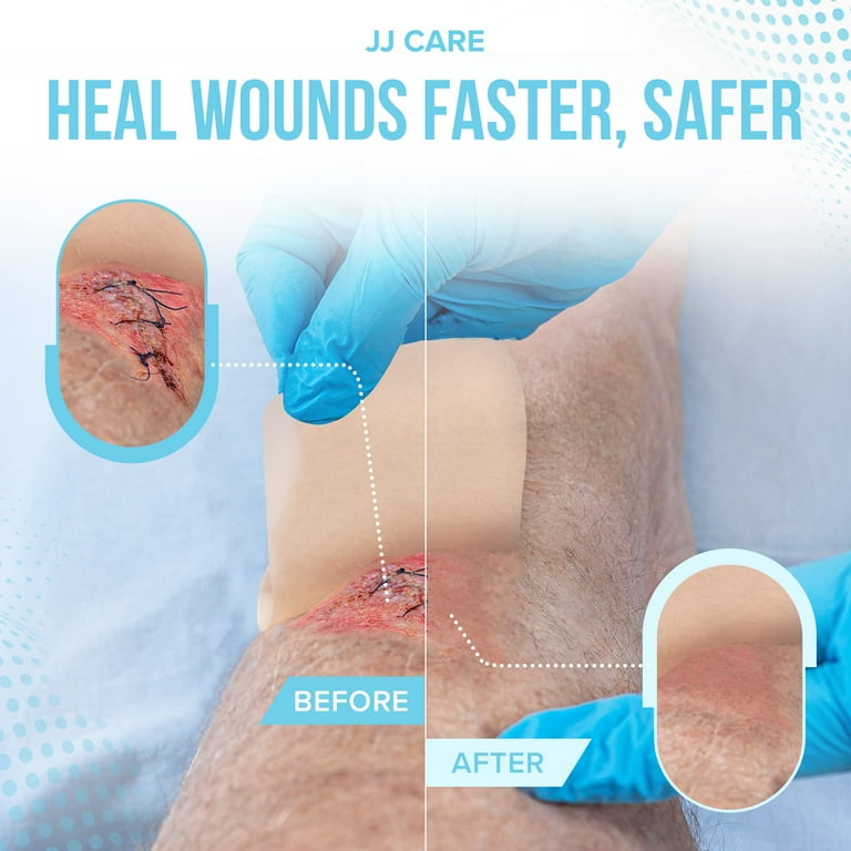 hydrocolloid dressing for deep cuts Hydrocolloid Bordered Dressing  Vive Health