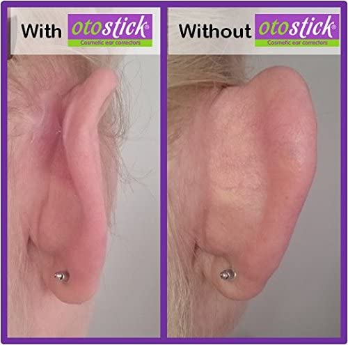 Otostick Ear Correctors For Prominent Ears (Twin Pack ) 