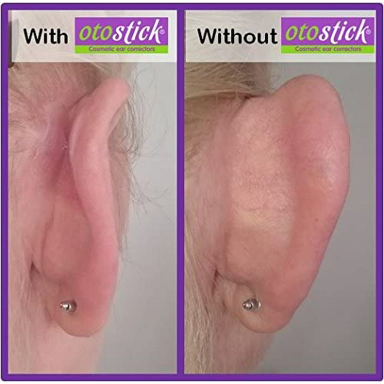 Otostick Baby, Aesthetic Correctors for Prominent Ears, Contains 8
