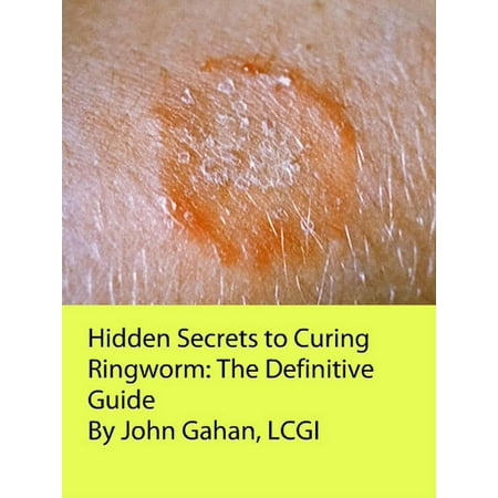 Hidden Secrets to Curing Ringworm: The Definitive Guide - (Best Medication For Ringworm Over The Counter)