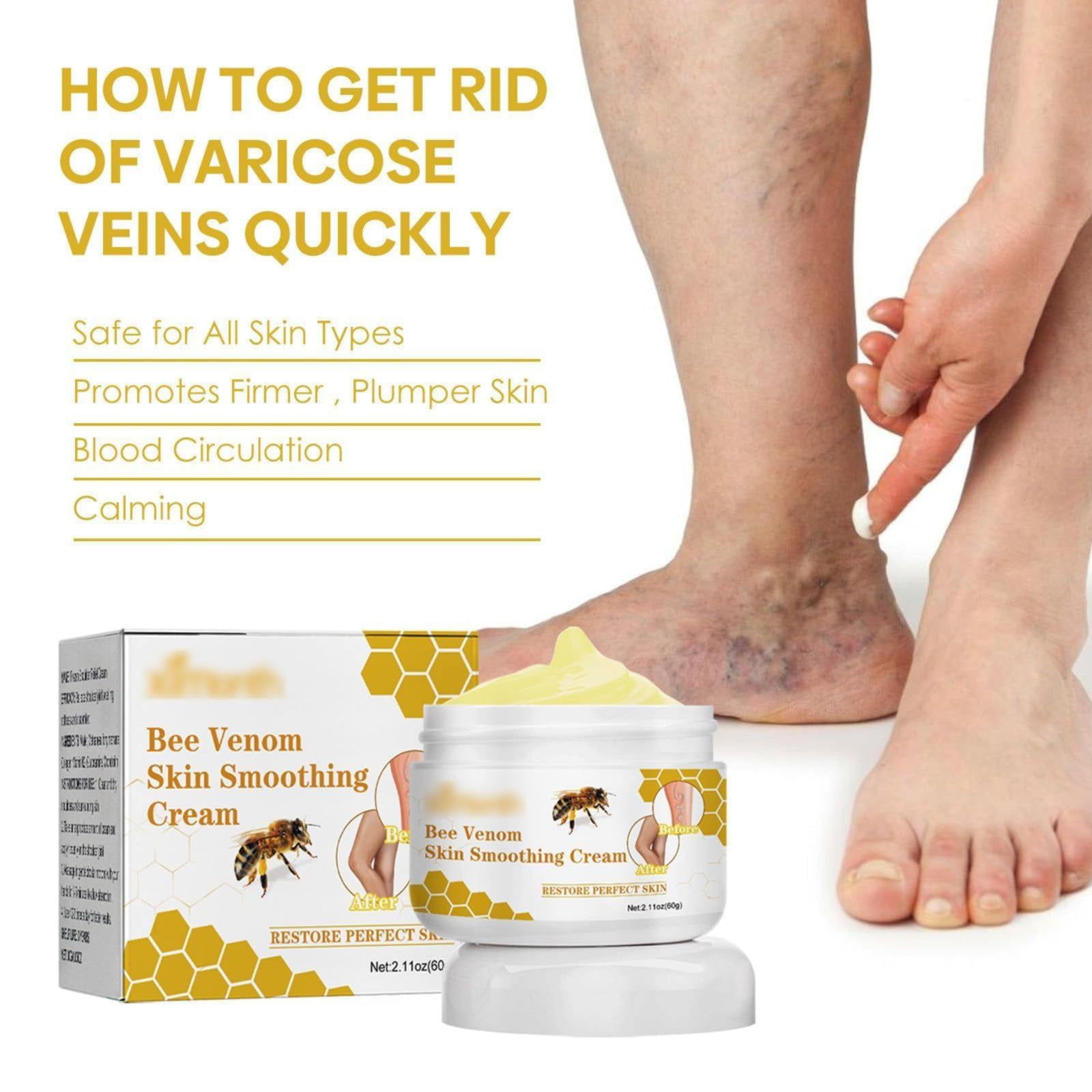 2packs Body Care,Varicose Vein Varicose Vein Rice Test Ointment ...